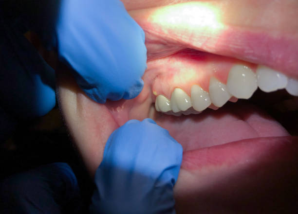 Best Emergency Dentist for Lost Fillings or Crowns in Wellsville, MO
